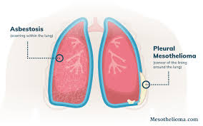 Understanding the Long-Term Health Risks of Asbestos Exposure