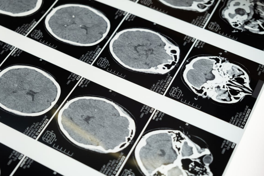 Understanding the Signs and Legal Implications of Brain Injuries After Accidents
